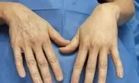 هزینه تزریق چربی به دست چقدر است؟