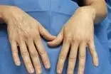هزینه تزریق چربی به دست چقدر است؟