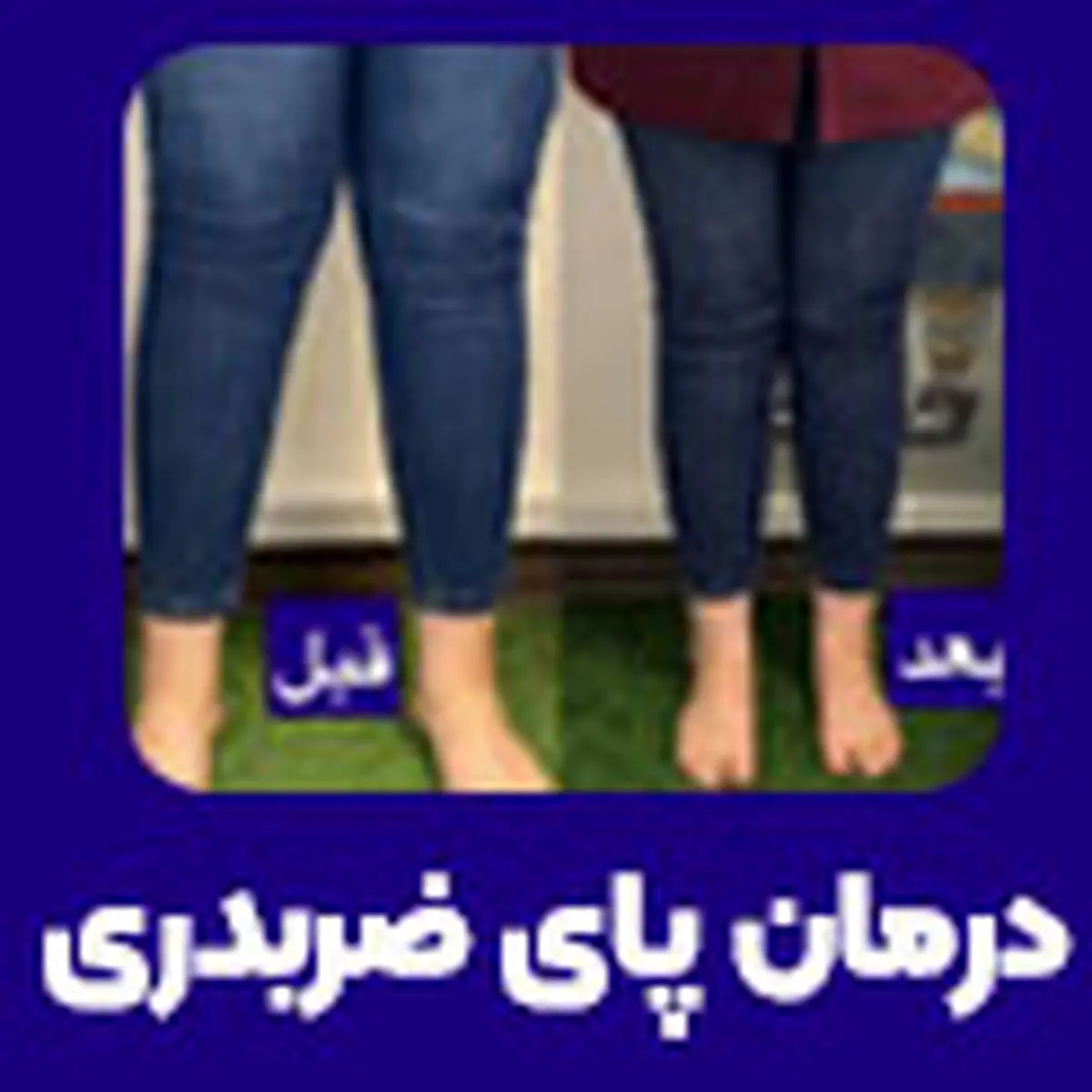 پای ایکس (ضربدری) چیست؟ روش‌های درمان آن