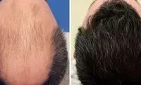 بهترین روش‌های کاشت مو کدامند؟