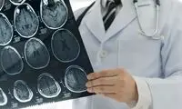 آمار غافلگیرکننده از سن سکته مغزی در ایران 
