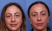بلفاروپلاستی با لیزر چگونه انجام می شود؟ + بررسی کاربرد و مزایا