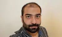 ۴۰ روز بعد از کاشت مو؛ چه انتظاری باید داشته باشید؟