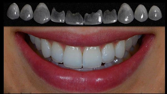 زیبایی دندان‌ ها با تراش کمتر