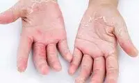 مراقب شایع‌ترین‌ بیماری‌های پوستی در نوروز باشید