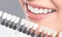 شرایط کامپوزیت دندان اقساطی چگونه است؟