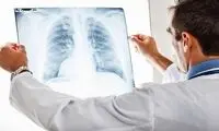این علائم نشانه خطرناکی برای ریه‌ها است 