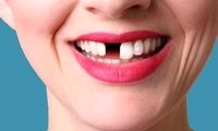 بهترین جایگزین برای دندان کشیده شده