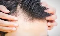 لیست داروهایی که سبب ریزش مو می‌شوند