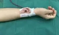 زنی که گوشش را در ساعدش، رشد می‌داد!
