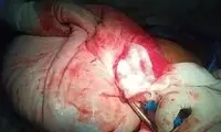 کیست ۱۵ کیلویی از شکم خانم ۲۲ ساله خارج شد