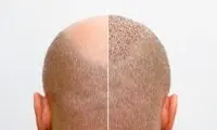 بهترین کلینیک‌های کاشت مو در کرج+ معرفی 10 کلینیک برتر