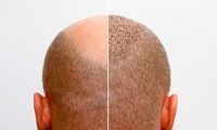 بهترین کلینیک‌های کاشت مو در کرج+ معرفی 10 کلینیک برتر
