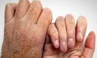 واکنش وزارت بهداشت به ماجرای شیوع بیماری جذام