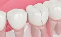 علائم و تشخیص «ترک دندان» و راه پیشگری از آن