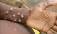 آخرین آمار آبله میمونی در جهان 