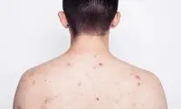 ۱۰ راهکار ساده و کاربردی برای درمان جوش بدن