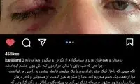 تصویر چشم زخمی انصاری‌فرد پس از جشن تولد 