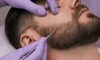 بهترین مرکز کاشت ریش در تهران | معرفی ۵ کلینیک معتبر برای کاشت ریش و سبیل