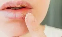 مبارزه با ویروس آنفلوآنزا و تبخال با آدامس لوبیا!