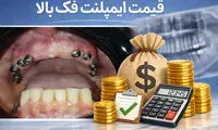 قیمت ایمپلنت فک بالا