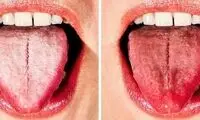 علت سفیدی زبان چیست و چطور برطرف می‌شود؟