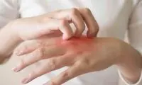 درمان پسوریازیس با روش های پزشکی و خانگی + نشانه های صدفک