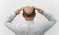 این ژل عجیب برای درمان طاسی معجزه می‌کند