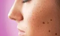 جای اسکار سالک با چه روش‌هایی انجام می‌شود + معرفی بهترین روش