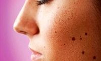 جای اسکار سالک با چه روش‌هایی انجام می‌شود + معرفی بهترین روش