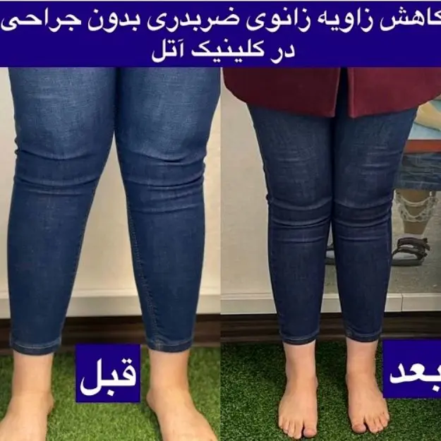بدون جراحی انحراف زانو تو درمان کن!! بدون درد راه برو