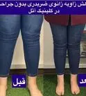پای ایکس (ضربدری) چیست و چگونه بدون جراحی درمان می‌شود