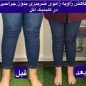 پای ایکس (ضربدری) چیست و چگونه بدون جراحی درمان می‌شود