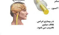 چه کار کنیم تا ام اس (MS) نگیریم؟