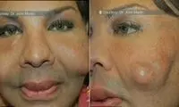 تزریق سیمان به جای بوتاکس در گونه + عکس