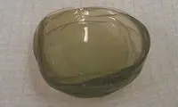 پیدا کردن 27 لنز طبی در چشم زن 67 ساله!