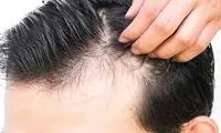 راه درمان ریزش مو پس از بیماری کرونا