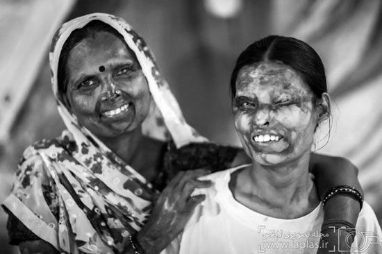 عکس: قربانیان اسیدپاشی در هند (18+)