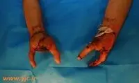 بازسازی گازانبری دستان قطع شده! +عکس