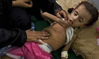 سوء تغذیه؛ قاتل اصلی کودکان در جهان