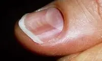 ناخن و دلایل بروز خمیدگی در آن