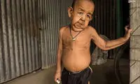 کودکی با چهره 80 ساله