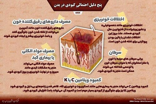 پنج دلیل احتمالیِ کبودی در بدن