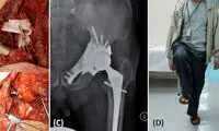 یکی دیگر از معجزات پزشکی پرینتر 3 بعدی