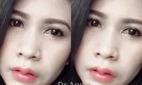 «شاخ بوفالو»؛ جراحی زیبایی عجیب در تایلند