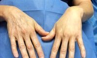 هزینه تزریق چربی به دست چقدر است؟