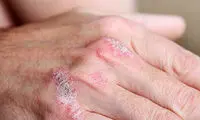 چگونه با پسوریازیس کنار بیاییم؟