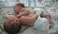 عکس: تولد نوزادان دوقلوی به هم چسبیده
