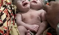 عکس: تولد نوزاد دو سر در بنگلادش
