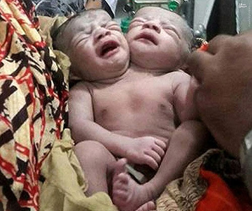 عکس: تولد نوزاد دو سر در بنگلادش